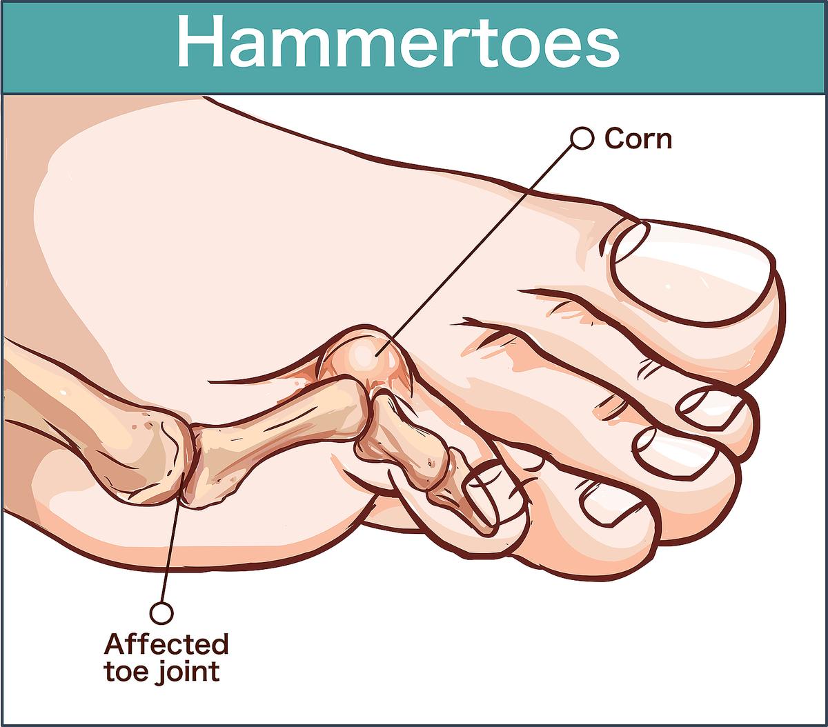 Hammer Toe Self-Care: Tips for Relief & Comfort