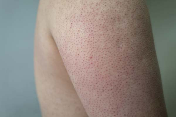 Keratosis Pilaris Self-Care: Top Tips for Smooth Skin